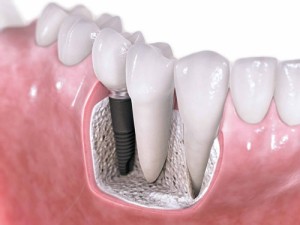 Khôi phục răng bị mất bằng phương pháp implant