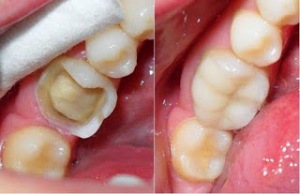 Bọc răng sứ có gây ra tác hại gì không? Boc-rang-su-co-gay-tac-hai-gi-khong-2
