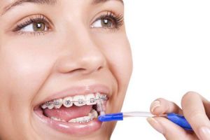 Chăm sóc răng miệng trong thời gian niềng răng Cham-soc-rang-mieng-trong-thoi-gian-nieng-rang