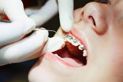 Chăm sóc răng miệng trong thời gian niềng răng Cham-soc-rang-mieng-trong-thoi-gian-nieng-rang1