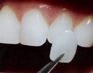 Tìm hiểu về răng sứ thẩm mỹ